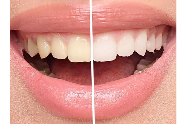 Zobu balināšana, terapija un mīti: kas patiesībā notiek ar tavu smaidu?