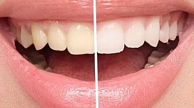 Zobu balināšana, terapija un mīti: kas patiesībā notiek ar tavu smaidu?